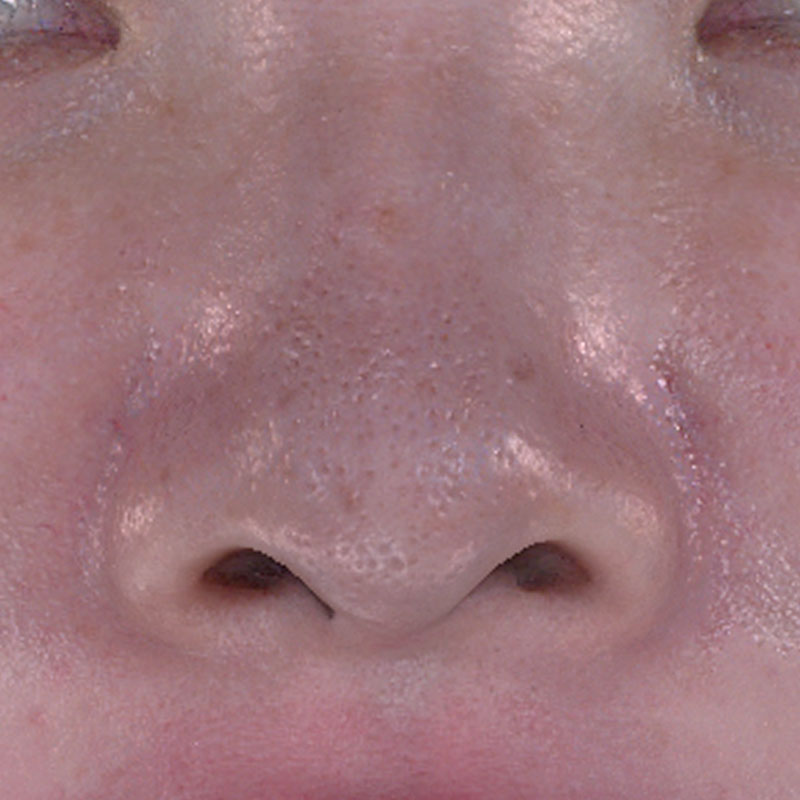 20251122_St20251122-5_fukuda_micro botox①Before