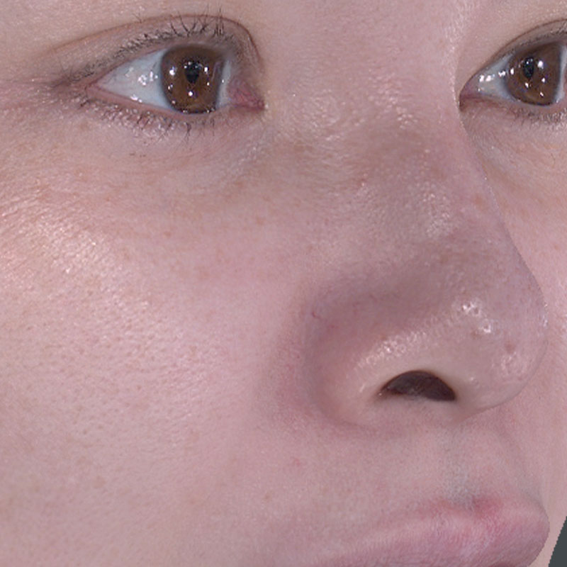 20251122_St20251122-5_fukuda_micro botox②After