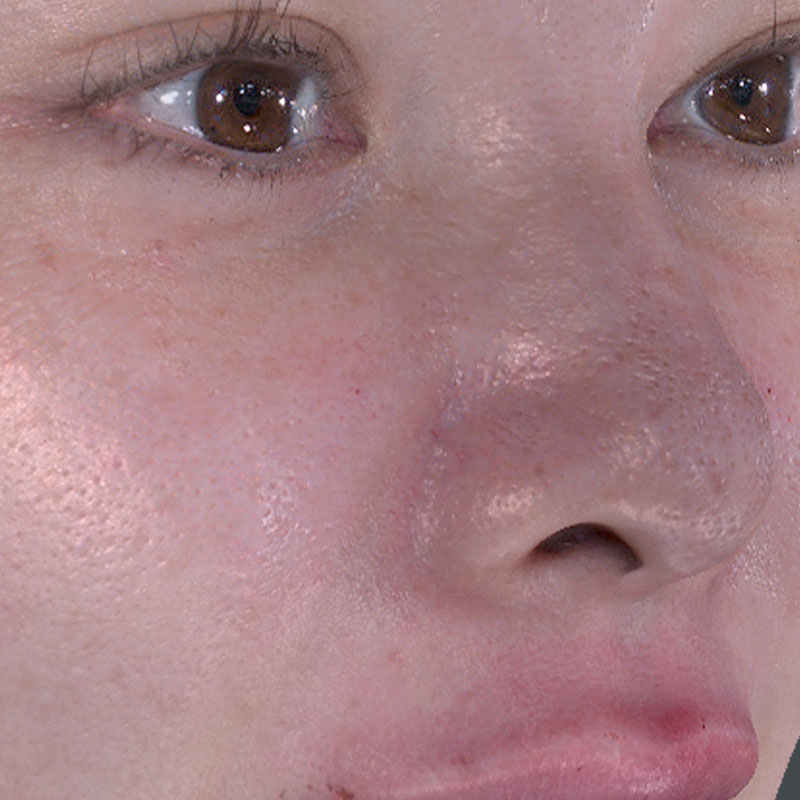 20251122_St20251122-5_fukuda_micro botox②Before