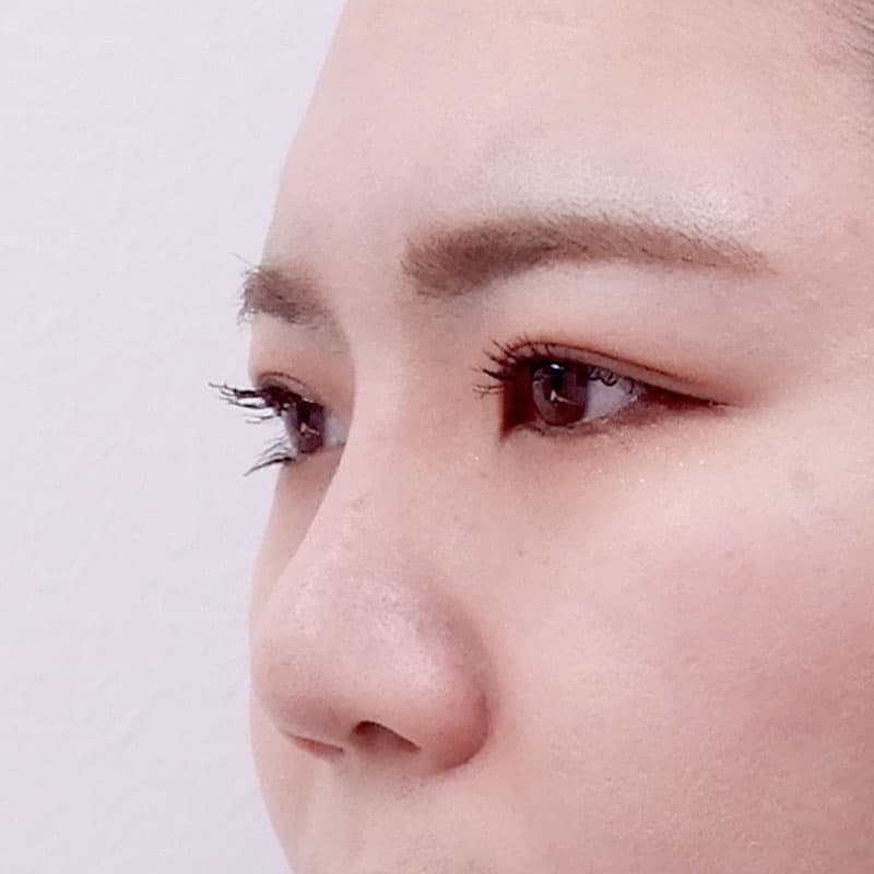 20251123_N15172_kaneko_nose-prosthesis①After