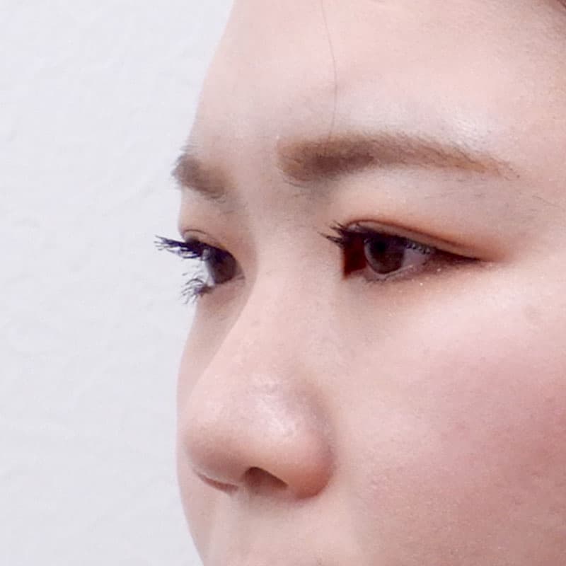 20251123_N15172_kaneko_nose-prosthesis①Before