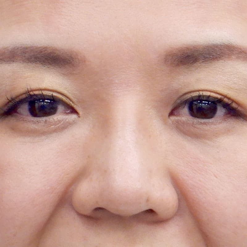 20251123_N33310_kaneko_nose-prosthesis①After