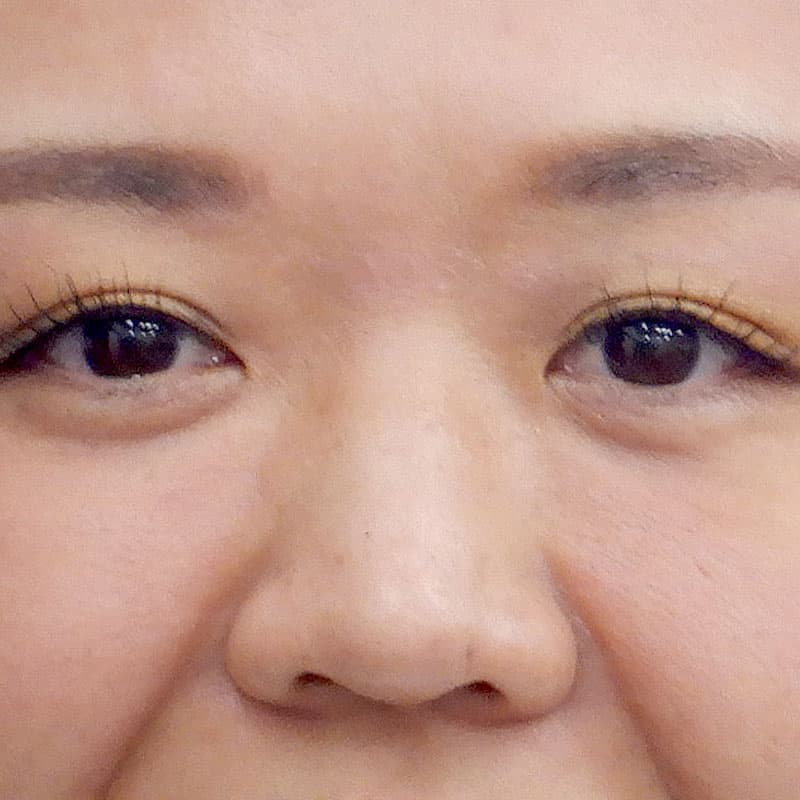 20251123_N33310_kaneko_nose-prosthesis①Before