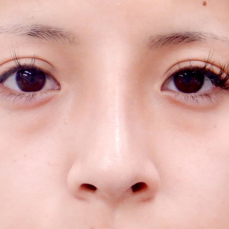 20251123_N36135_kaneko_nose-prosthesis①After