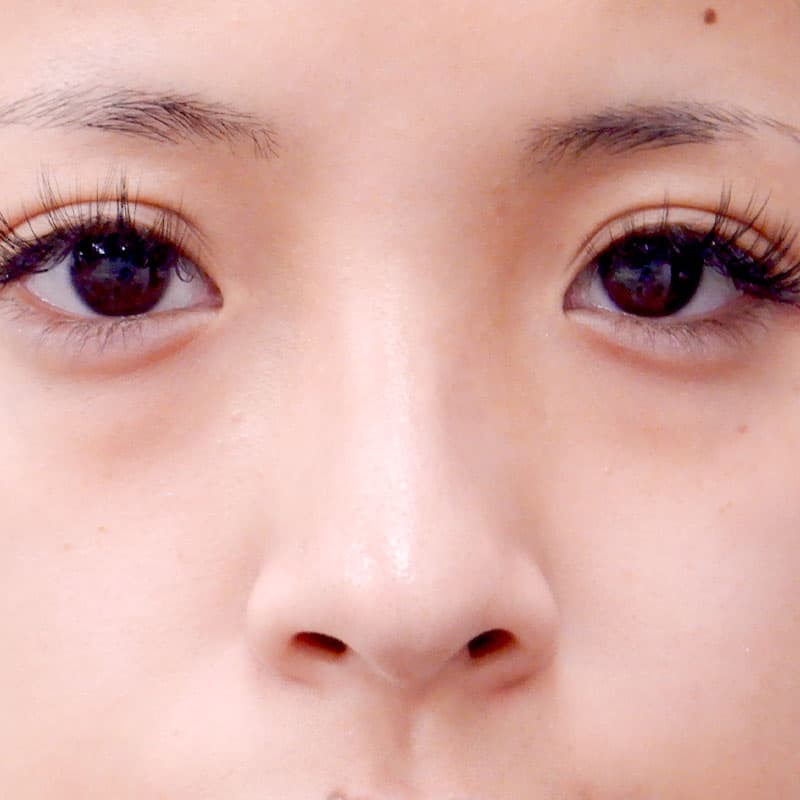 20251123_N36135_kaneko_nose-prosthesis①Before