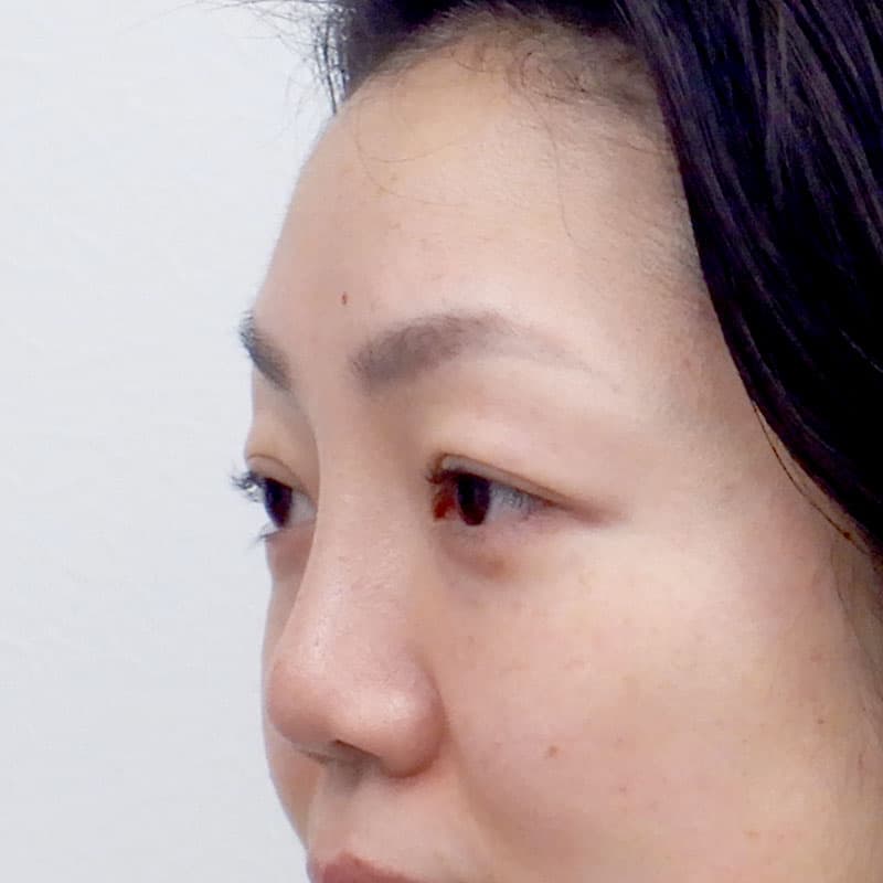 20251123_N36682_kaneko_nose-prosthesis①After
