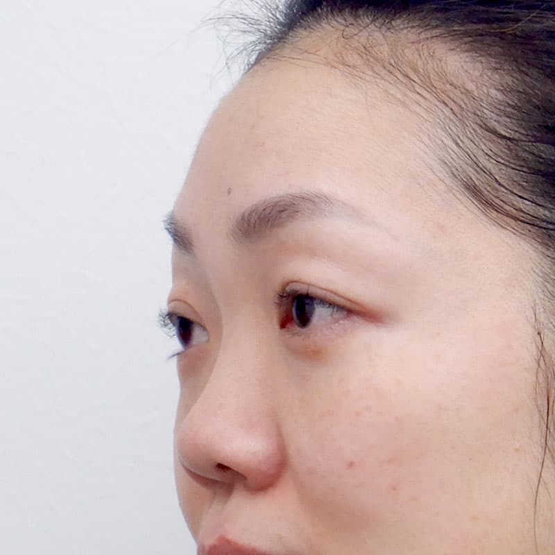 20251123_N36682_kaneko_nose-prosthesis①Before