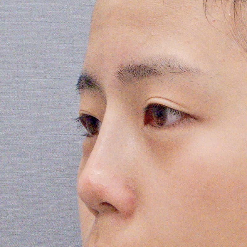 20251123_N37870_kaneko_nose-prosthesis①After