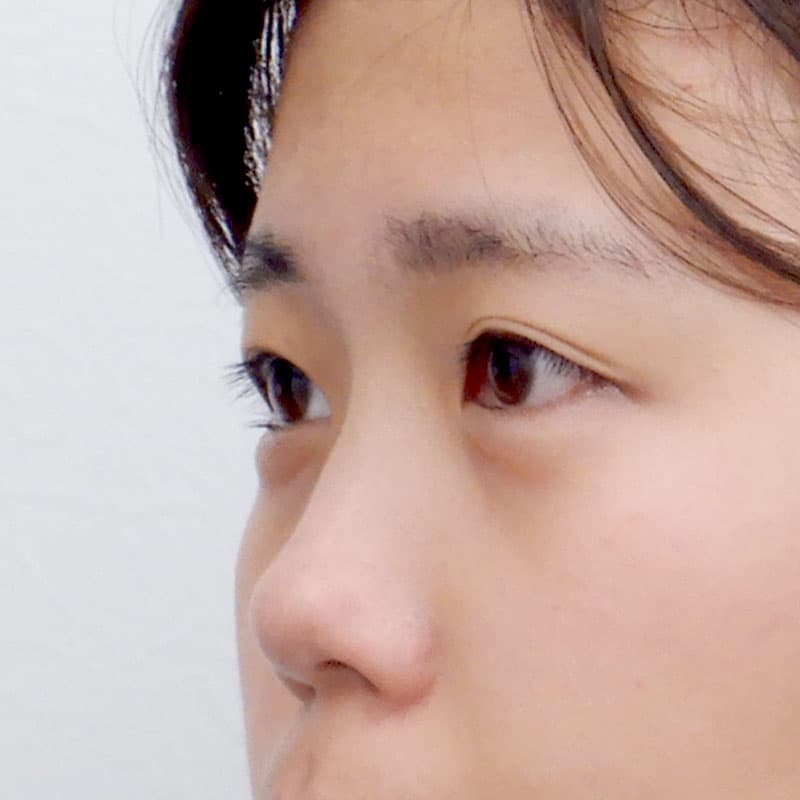 20251123_N37870_kaneko_nose-prosthesis①Before