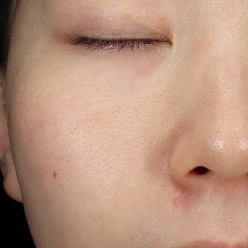 20251123_St20251123-1_mayuko_micro botox①After