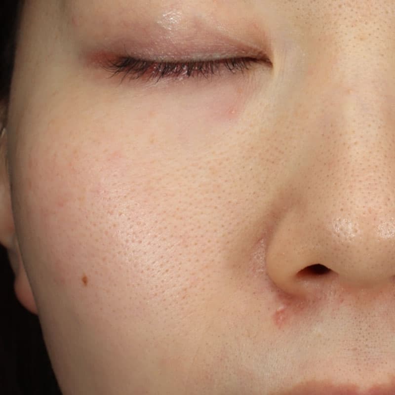 20251123_St20251123-1_mayuko_micro botox①Before