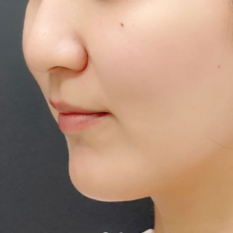 20250928_St20251212-3_tanaka_hyaluronic acid lift①After