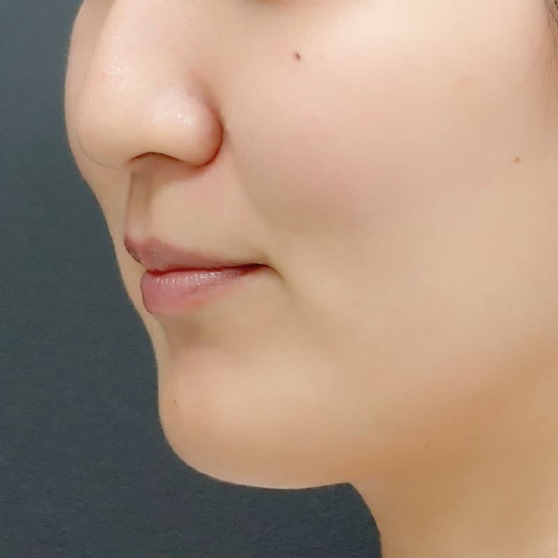 20250928_St20251212-3_tanaka_hyaluronic acid lift①Before