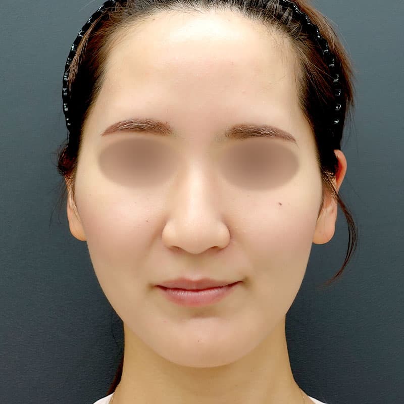 20250928_St20251212-3_tanaka_hyaluronic acid lift②After