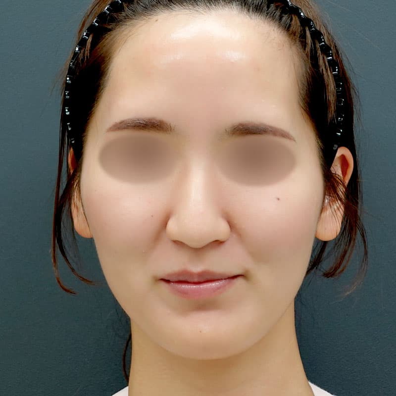 20250928_St20251212-3_tanaka_hyaluronic acid lift②Before