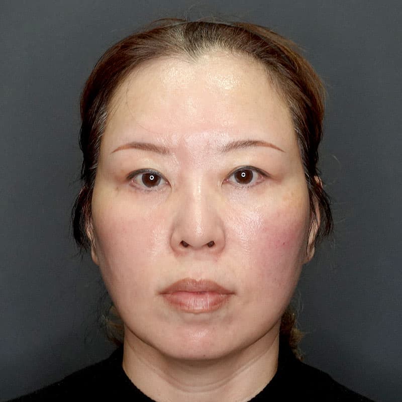 20251127_N142270_nagahama_extended MACSlift②After