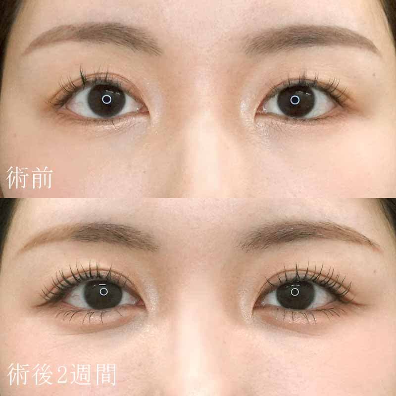 20251201_F157648_kadoya_double-burial-method_hyaluronic acid tear bagメイン横