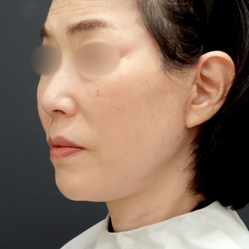 20251203_N125940_morishima_extended MACSlift-neck lift①After