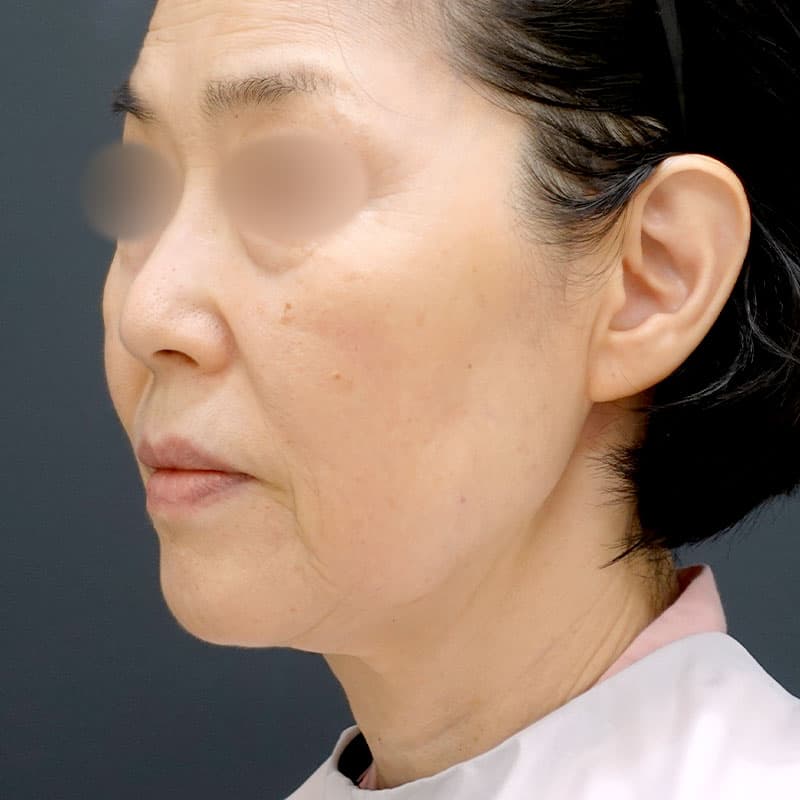 20251203_N125940_morishima_extended MACSlift-neck lift①Before