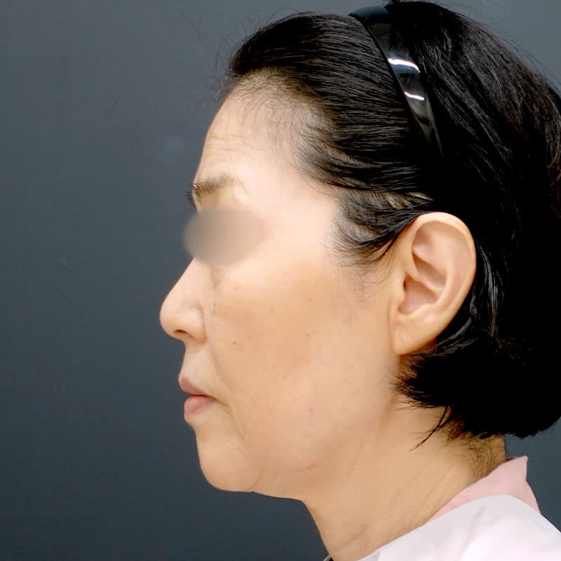 20251203_N125940_morishima_extended MACSlift-neck lift②Before