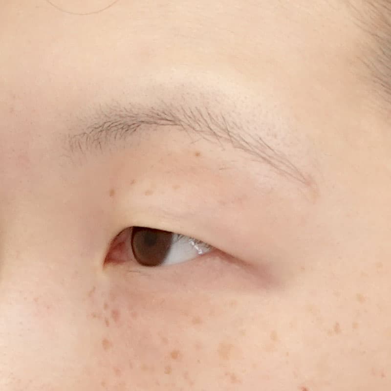 20251203_N140357_morishima_under-eyebrow incision②Before