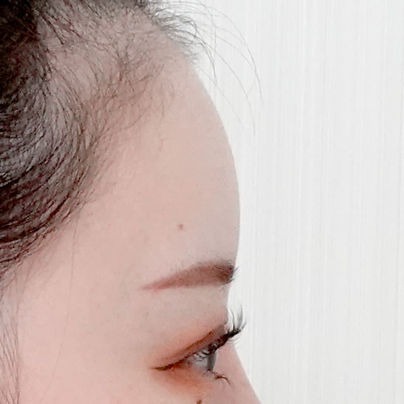 20251212_20251212_tanaka_hyaluronic forehead①After