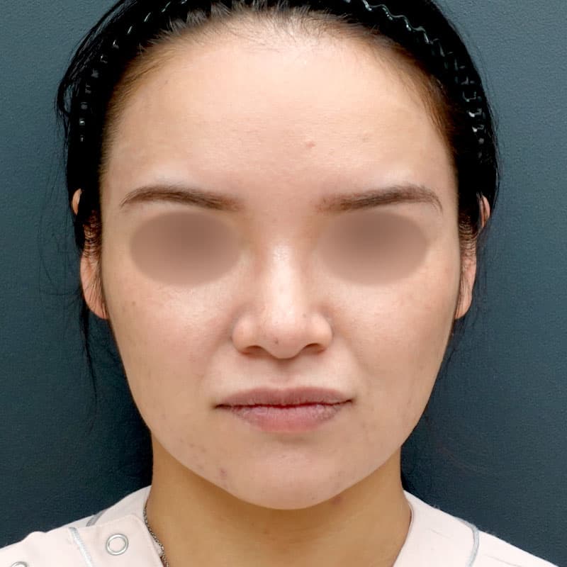 20251212_St20251212-1_tanaka_hyaluronic acid lift①Before