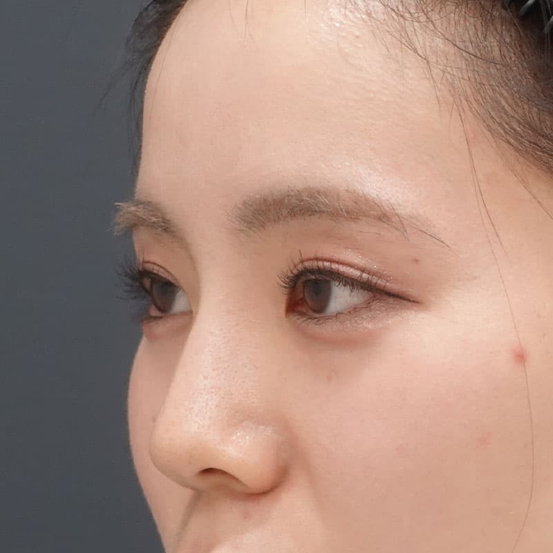 20251212_St20251212-2_tanaka_hyaluronic nose①After