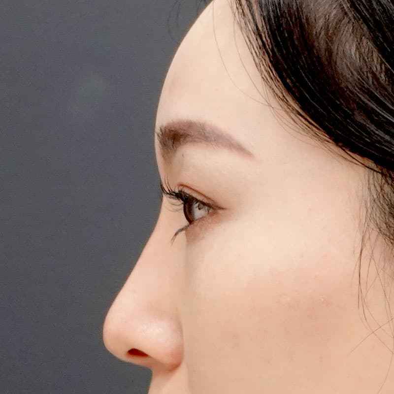 20251212_St20251212-6_tanaka_hyaluronic nose①After