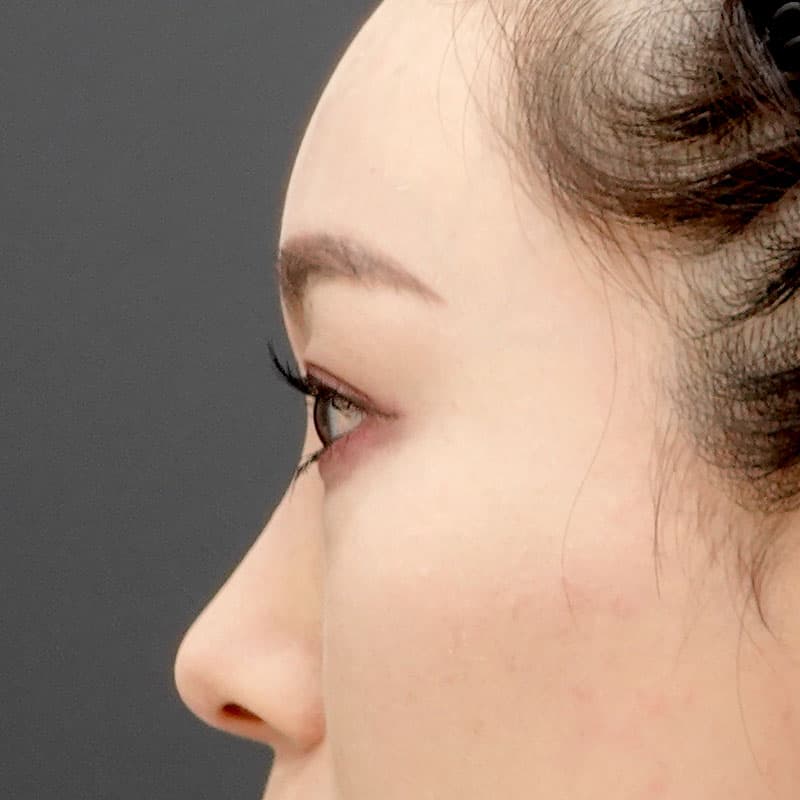 20251212_St20251212-6_tanaka_hyaluronic nose①Before