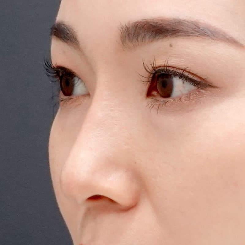 20251212_St20251212-6_tanaka_hyaluronic nose②After