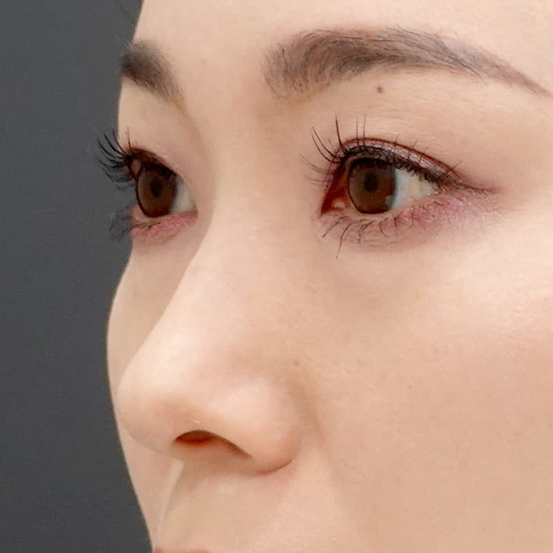 20251212_St20251212-6_tanaka_hyaluronic nose②Before