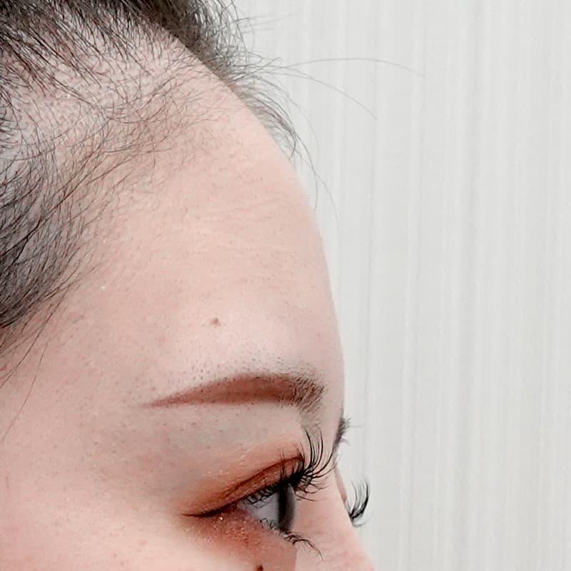 20251212_St20251212_tanaka_hyaluronic forehead①Before