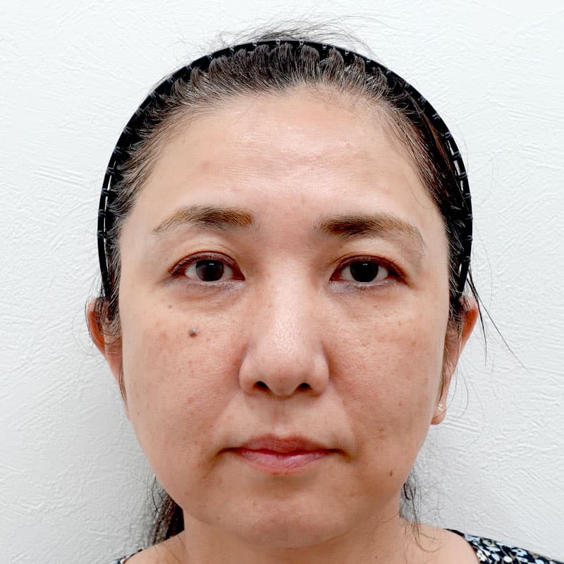 20251215_G30538_takee_face lift①Before