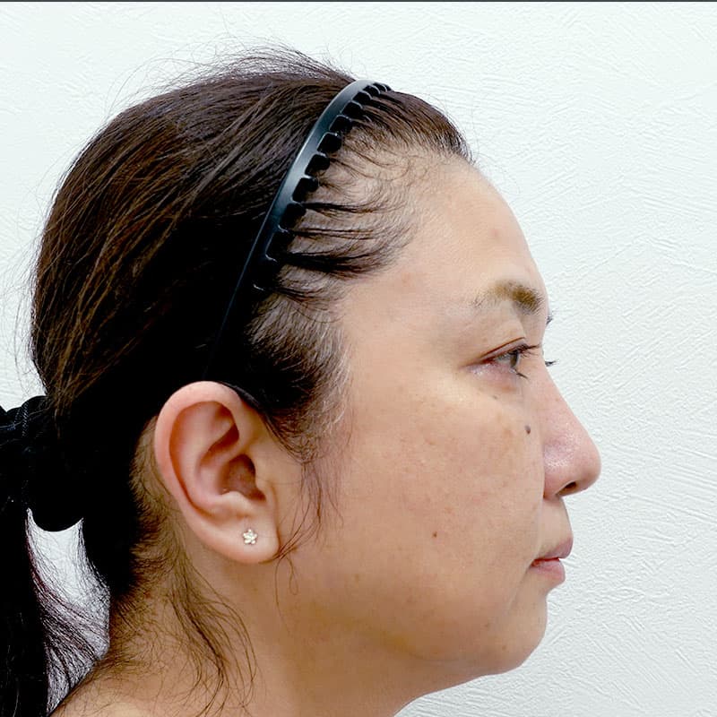 20251215_G30538_takee_face lift②Before