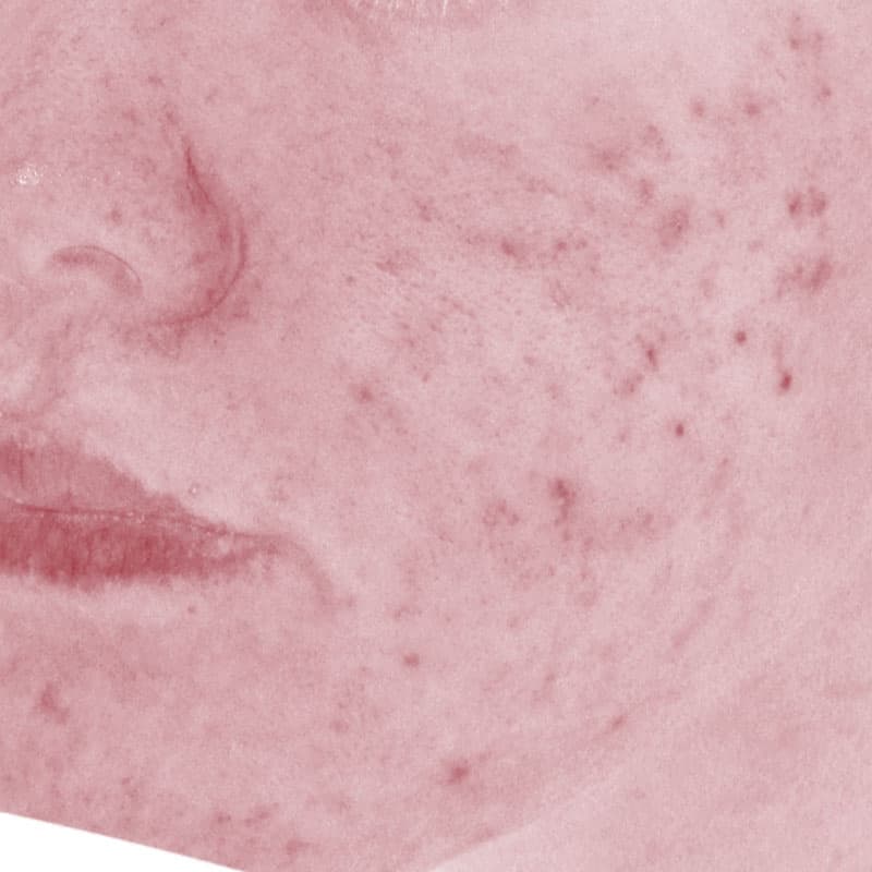 20251222_N135120_Macrogol Peeling①After