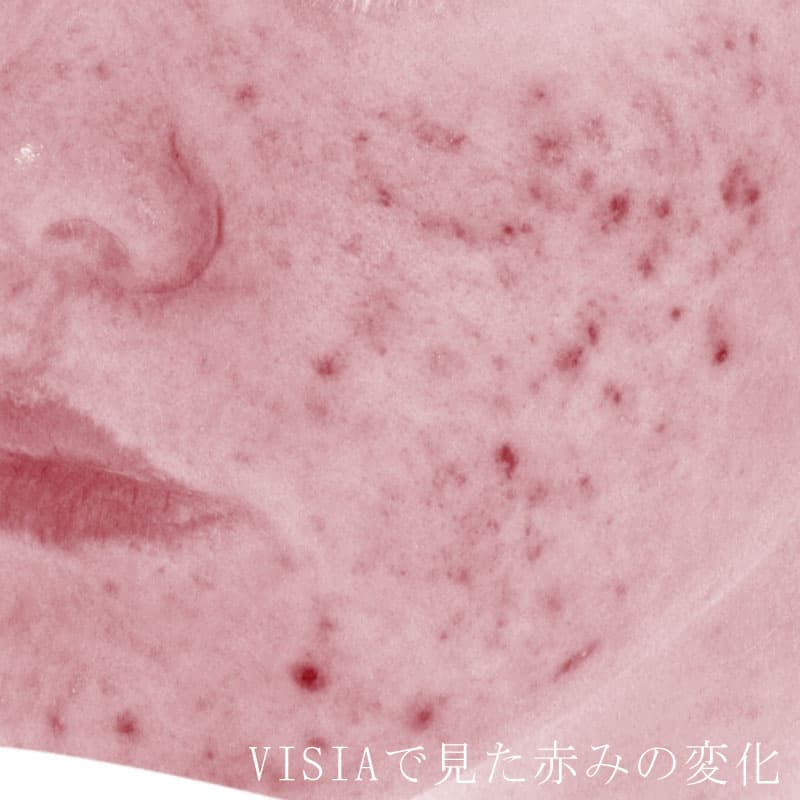 20251222_N135120_Macrogol Peeling①Before