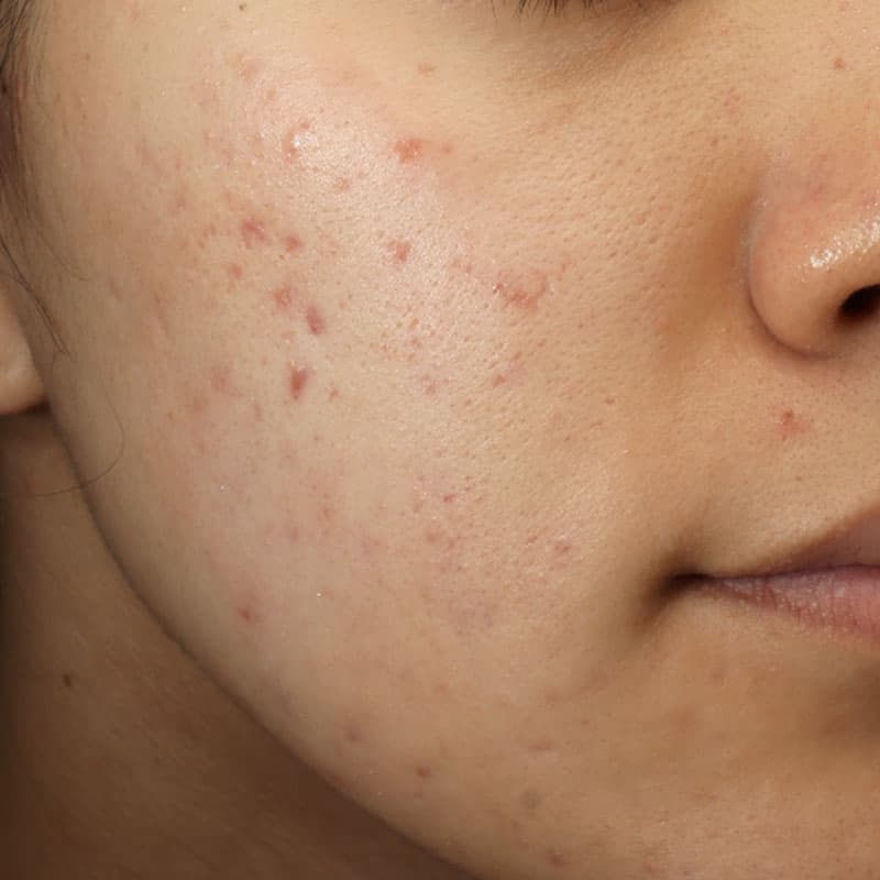 20251222_N135120_Macrogol Peeling②After