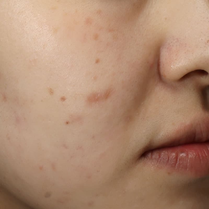 20251222_N44938_Macrogol Peeling①After