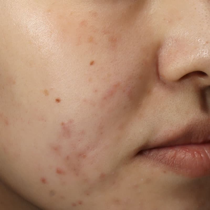 20251222_N44938_Macrogol Peeling①Before