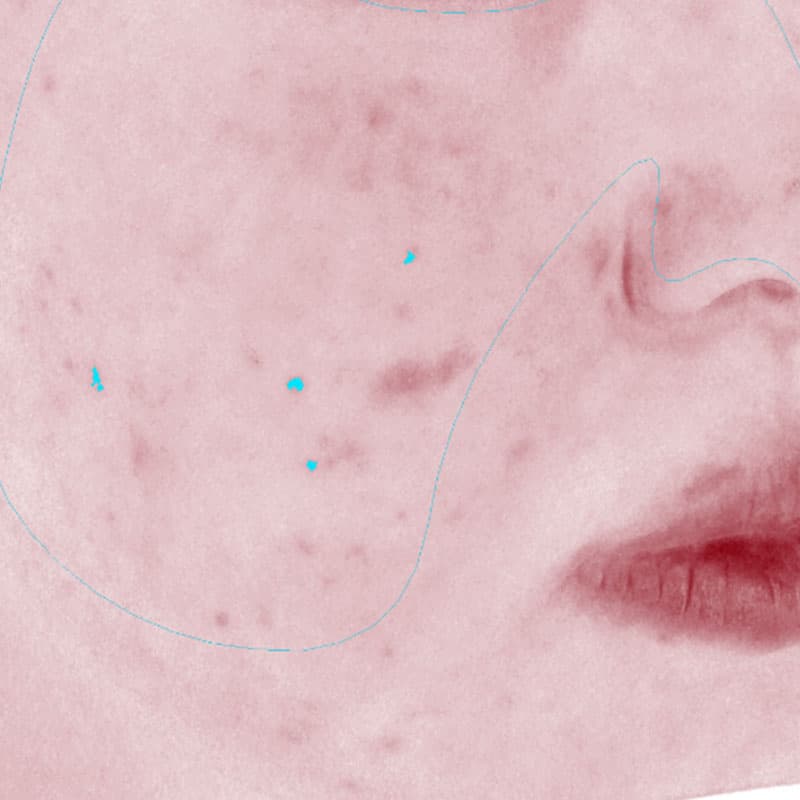 20251222_N44938_Macrogol Peeling②After