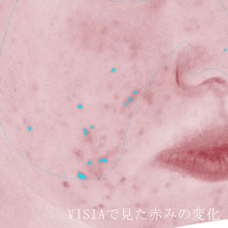 20251222_N44938_Macrogol Peeling②Before