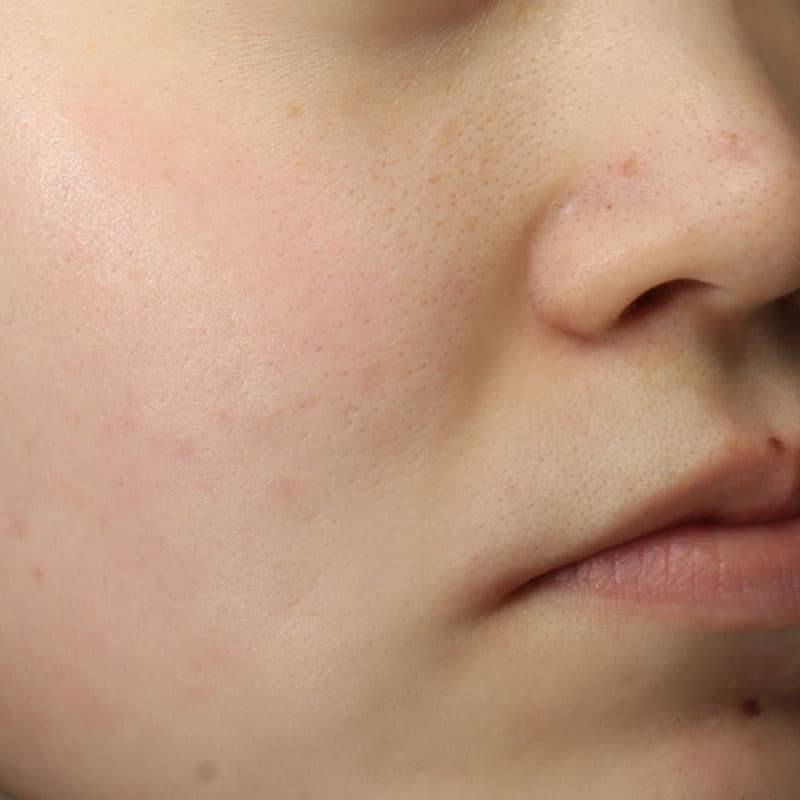 20251222_N50462_dermapen①After