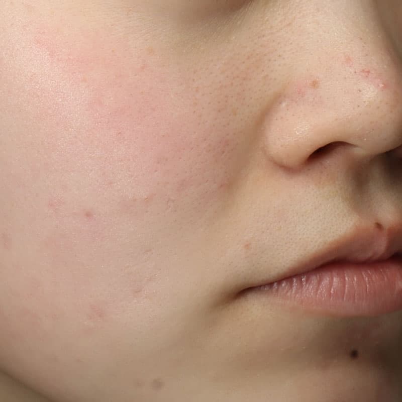 20251222_N50462_dermapen①Before