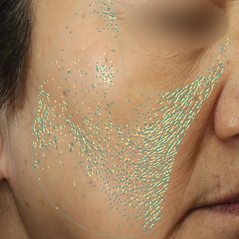 20251223_N100062_picolaser①After