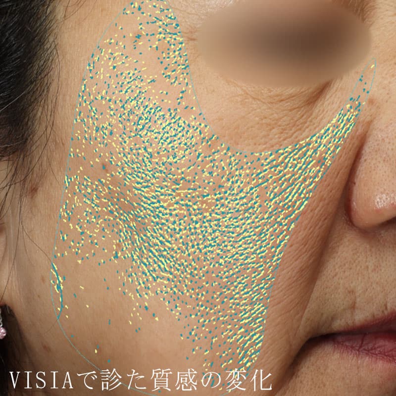 20251223_N100062_picolaser①Before