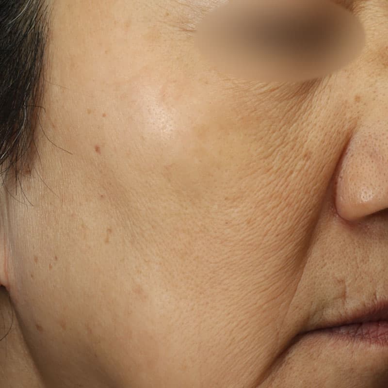 20251223_N100062_picolaser②After