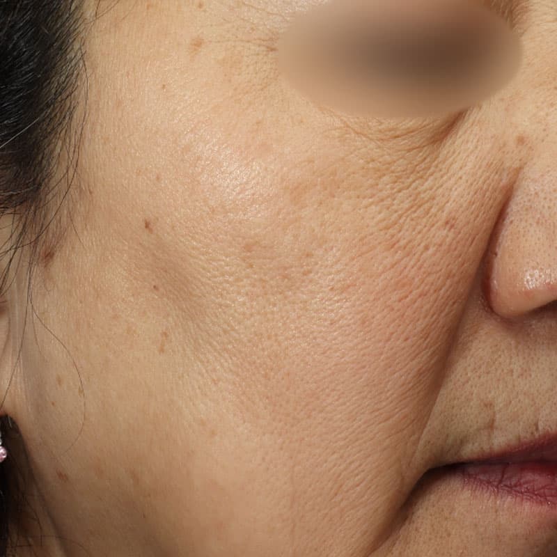 20251223_N100062_picolaser②Before