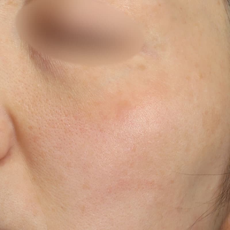 20251223_N127718_picolaser②After