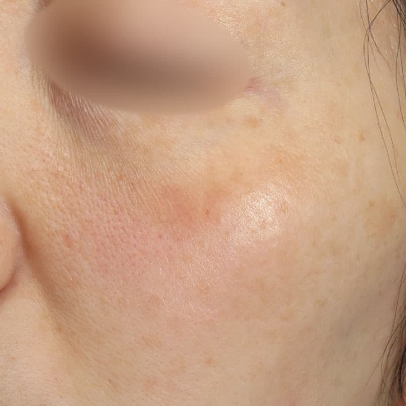 20251223_N127718_picolaser②Before